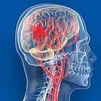 Enxaqueca e Derrame, AVC, Acidente Vascular Cerebral avc derrame acidente vascular cerebral Enxaqueca e Derrame, AVC, Acidente Vascular Cerebral