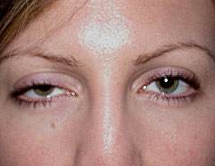 ptose palpebral palpbr Enxaqueca e os Olhos